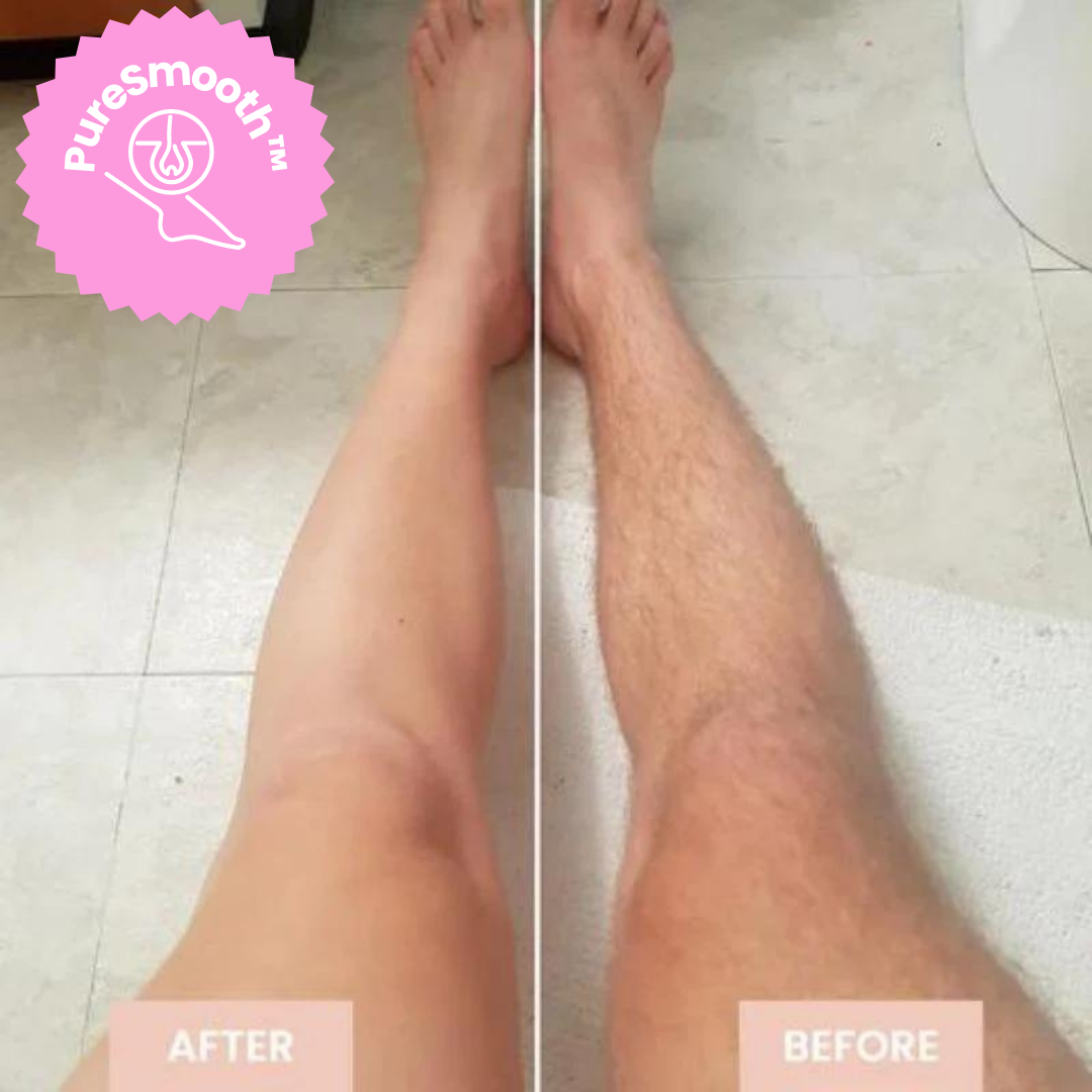 LaserSchlösser™ Rinforza le radici dei capelli